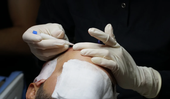 DHI Hair Transplantation
