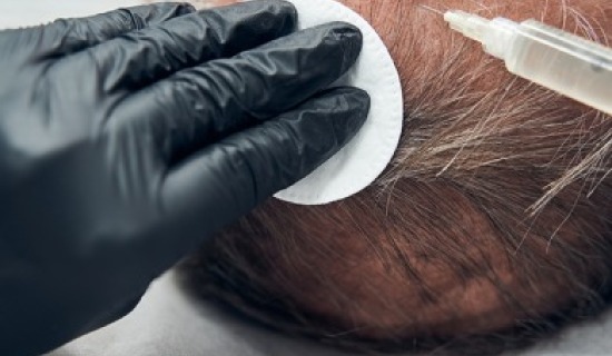 Sapphire FUE Hair Transplant