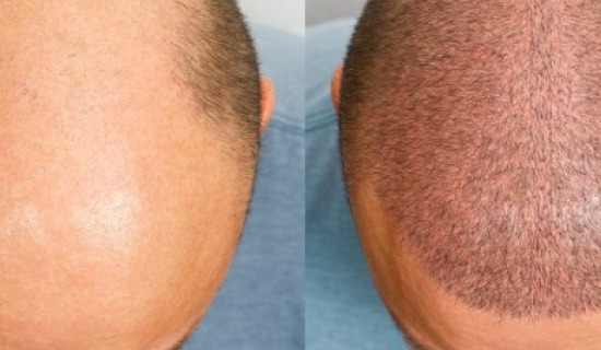 Hair Transplant