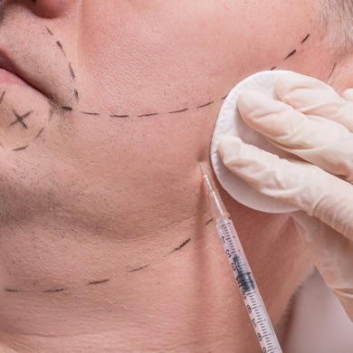 Beard Transplant
