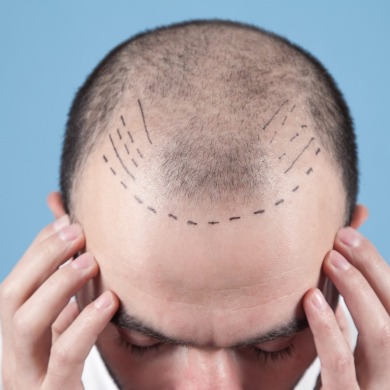  Hair Transplant Cost