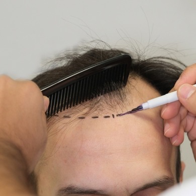Long DHI Hair Transplant