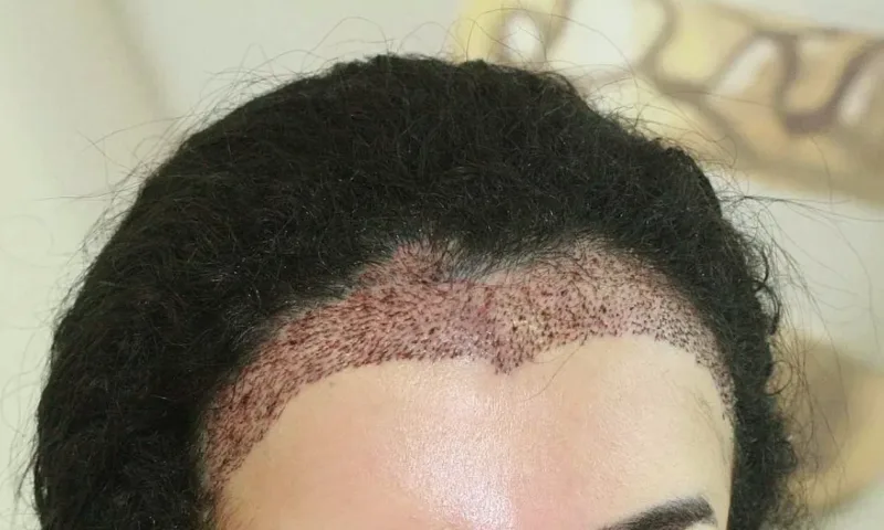 Greffe de Cheveux pour Femmes