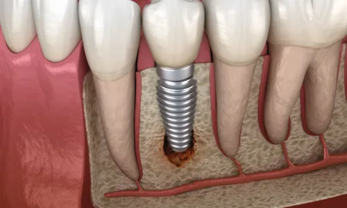 Trattamento Implantare