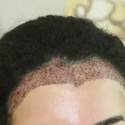 Trapianto di Capelli per Donne