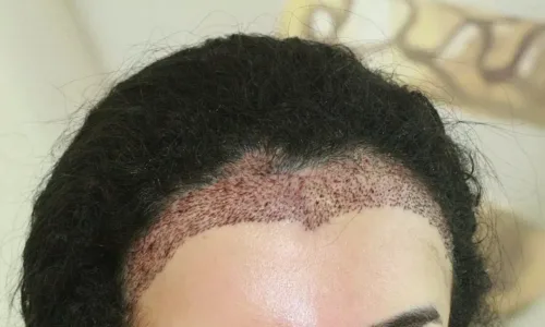 Trapianto di Capelli per Donne