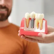 Trattamento di Impianti Dentali in Turchia