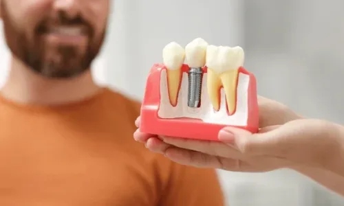 Trattamento di Impianti Dentali in Turchia