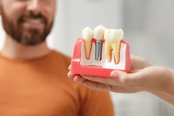 Trattamento di Impianti Dentali in Turchia