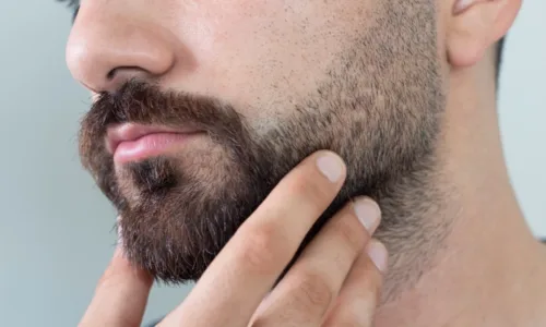 Greffe de Barbe