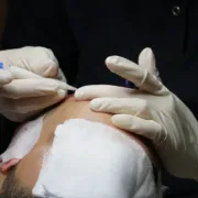 Saç Ekimi Türkiye