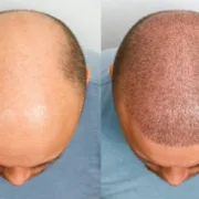 Greffe de Cheveux Sans Rasage