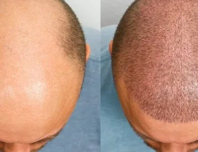Greffe de Cheveux Sans Rasage