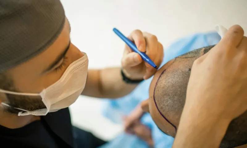Saç Ekiminde Merdivenaltı Kliniklerden Uzak Durun