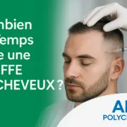Combien de Temps Dure une Greffe de Cheveux ?