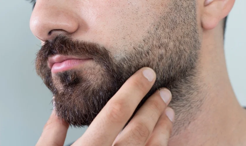 Trapianto di barba e sopracciglia