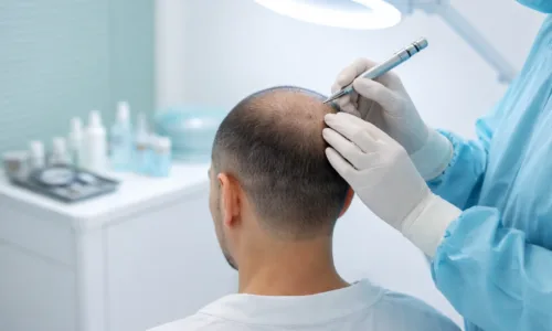 Trapianto di Capelli