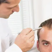 Long DHI Hair Transplant