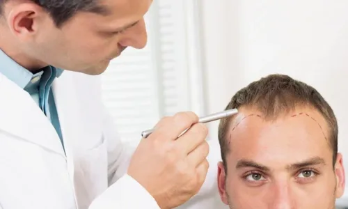 Long DHI Hair Transplant